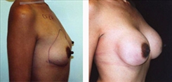 Breast Augmentation Patient Before & After Photo 1