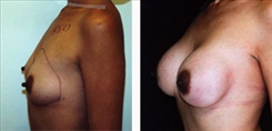 Breast Augmentation Patient Before & After Photo 1