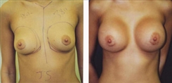 Breast Augmentation Patient Before & After Photo 1