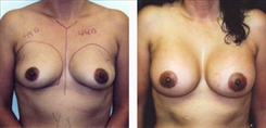 Breast Augmentation Patient Before & After Photo 1