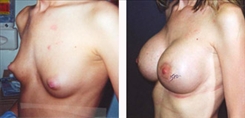 Breast Augmentation Patient Before & After Photo 1