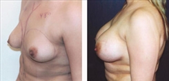 Breast Augmentation Patient Before & After Photo 1