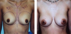 Breast Augmentation Patient Before & After Photo 1