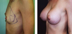 Breast Augmentation Patient Before & After Photo 1