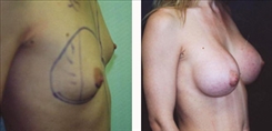 Breast Augmentation Patient Before & After Photo 1