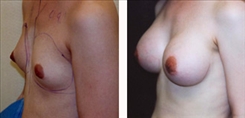 Breast Augmentation Patient Before & After Photo 1