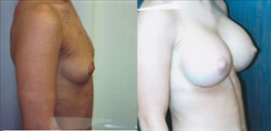 Breast Augmentation Patient Before & After Photo 1