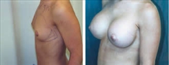 Breast Augmentation Patient Before & After Photo 1