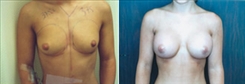 Breast Augmentation Patient Before & After Photo 1