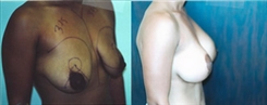 Breast Augmentation Patient Before & After Photo 1