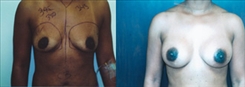 Breast Augmentation Patient Before & After Photo 1