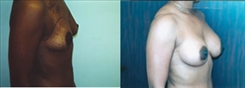 Breast Augmentation Patient Before & After Photo 1