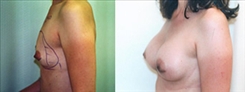 Breast Augmentation Patient Before & After Photo 1