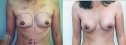 Breast Augmentation Patient Before & After Photo 1