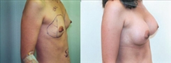 Breast Augmentation Patient Before & After Photo 1