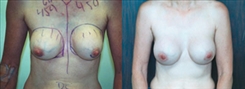 Breast Augmentation Patient Before & After Photo 1