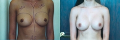 Breast Augmentation Patient Before & After Photo 1