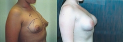 Breast Augmentation Patient Before & After Photo 1