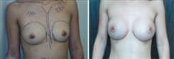 Breast Augmentation Patient Before & After Photo 1