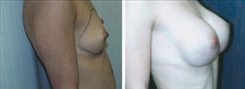 Breast Augmentation Patient Before & After Photo 1