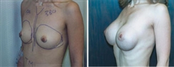 Breast Augmentation Patient Before & After Photo 1