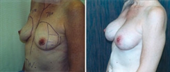 Breast Augmentation Patient Before & After Photo 1