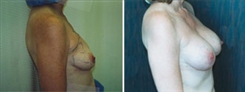 Breast Augmentation Patient Before & After Photo 1