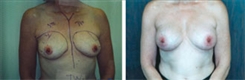 Breast Augmentation Patient Before & After Photo 1