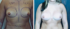 Breast Augmentation Patient Before & After Photo 1