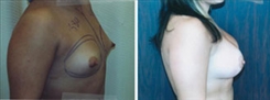 Breast Augmentation Patient Before & After Photo 1