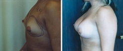 Breast Augmentation Patient Before & After Photo 1