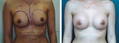 Breast Augmentation Patient Before & After Photo 1