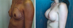 Breast Augmentation Patient Before & After Photo 1