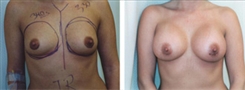 Breast Augmentation Patient Before & After Photo 1