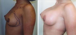 Breast Augmentation Patient Before & After Photo 1