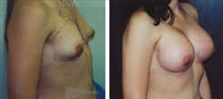 Breast Augmentation Patient Before & After Photo 1