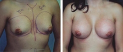 Breast Augmentation Patient Before & After Photo 1