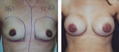 Breast Augmentation Patient Before & After Photo 1