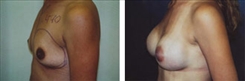 Breast Augmentation Patient Before & After Photo 1