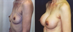 Breast Augmentation Patient Before & After Photo 1