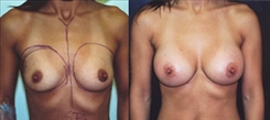 Breast Augmentation Patient Before & After Photo 1