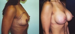 Breast Augmentation Patient Before & After Photo 1