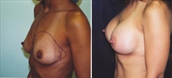 Breast Augmentation Patient Before & After Photo 1