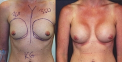 Breast Augmentation Patient Before & After Photo 1