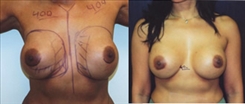 Breast Augmentation Patient Before & After Photo 1