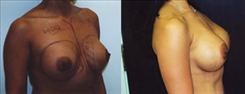 Breast Augmentation Patient Before & After Photo 1