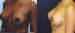 Breast Augmentation Patient Before & After Photo 1