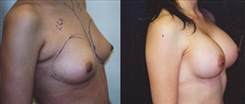 Breast Augmentation Patient Before & After Photo 1