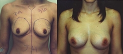 Breast Augmentation Patient Before & After Photo 1