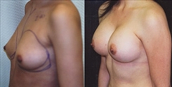 Breast Augmentation Patient Before & After Photo 1